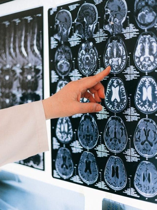 IA pode ajudar a prever avanço dos sintomas de Alzheimer, mostra estudo