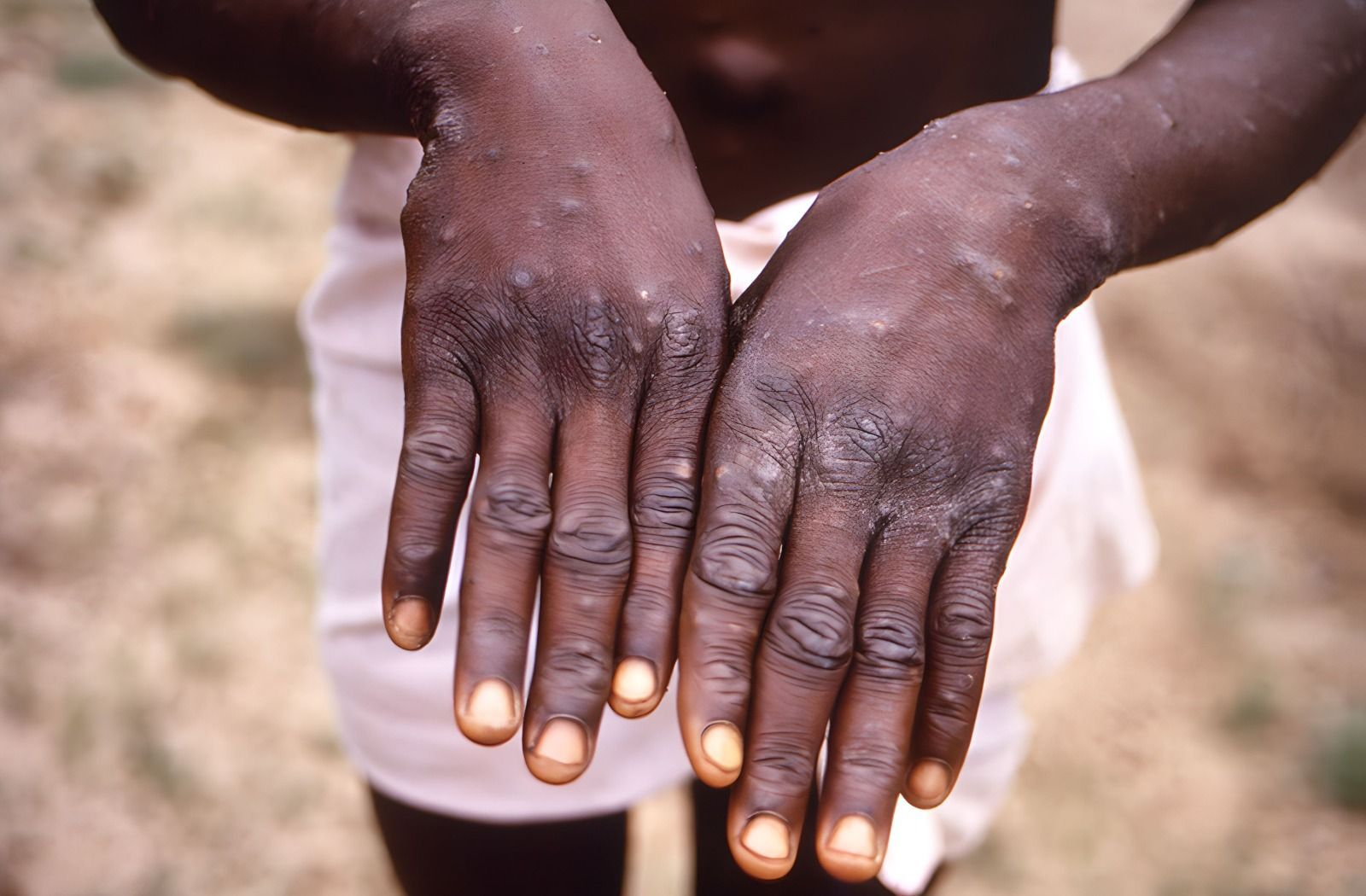 Mpox: veja perguntas e respostas sobre a doença