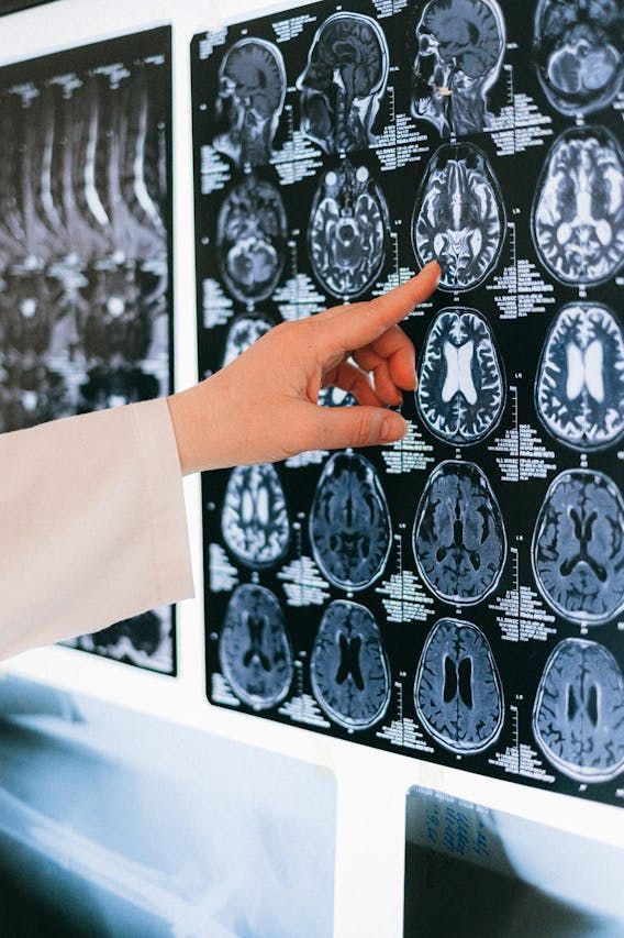 O que é hemorragia intracraniana e quais são as causas? Entenda