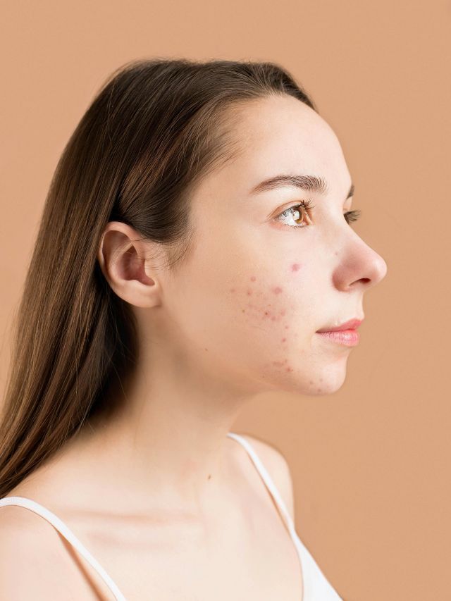 Cravos e espinhas: quais produtos realmente ajudam a preveni-los