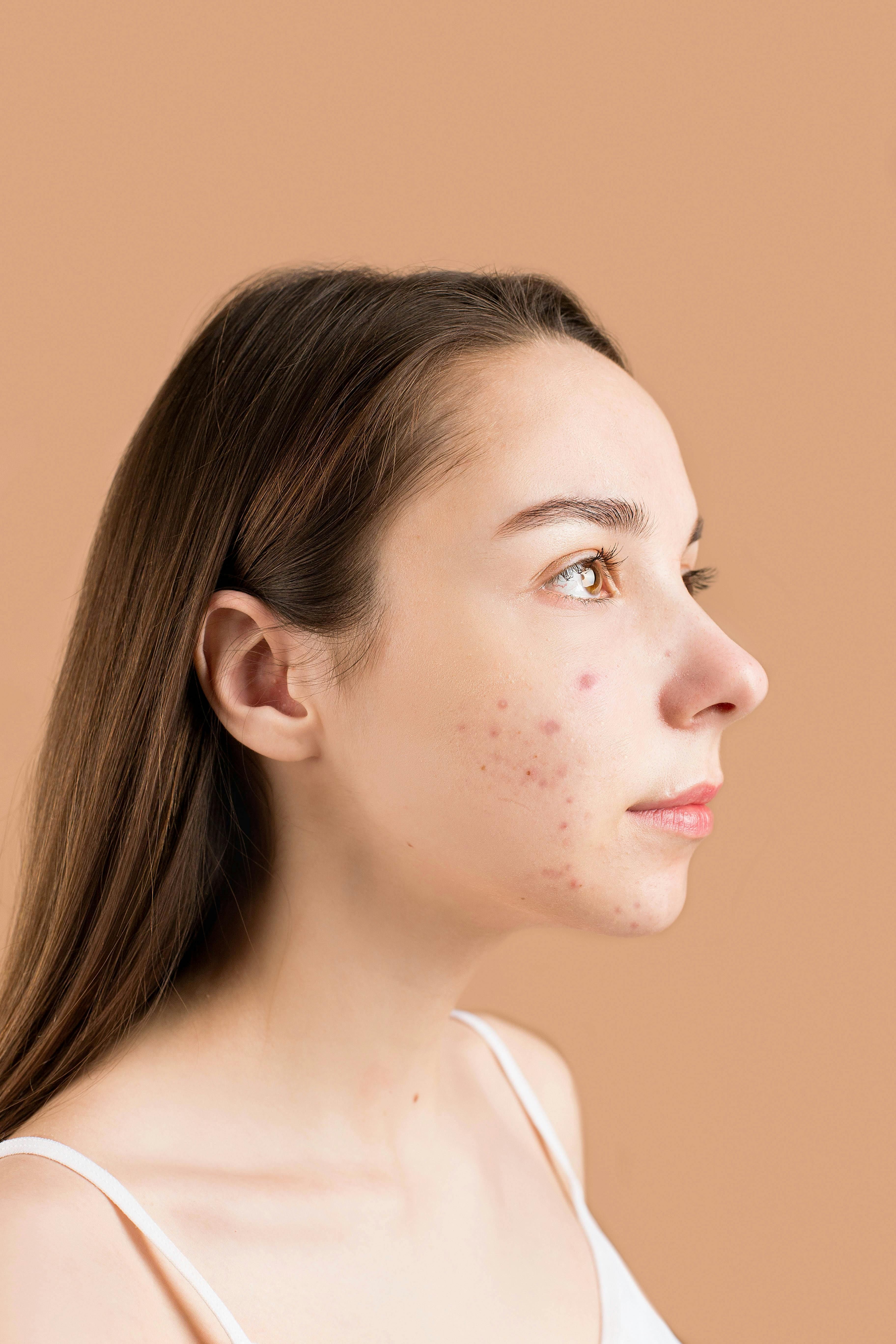 Cravos e espinhas: quais produtos realmente ajudam a preveni-los