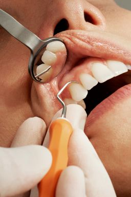 Cáries e doença da gengiva aumentam risco de AVC, diz estudo