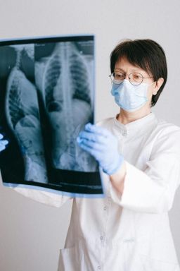 Casos de osteoporose devem disparar até 2050, inclusive no Brasil