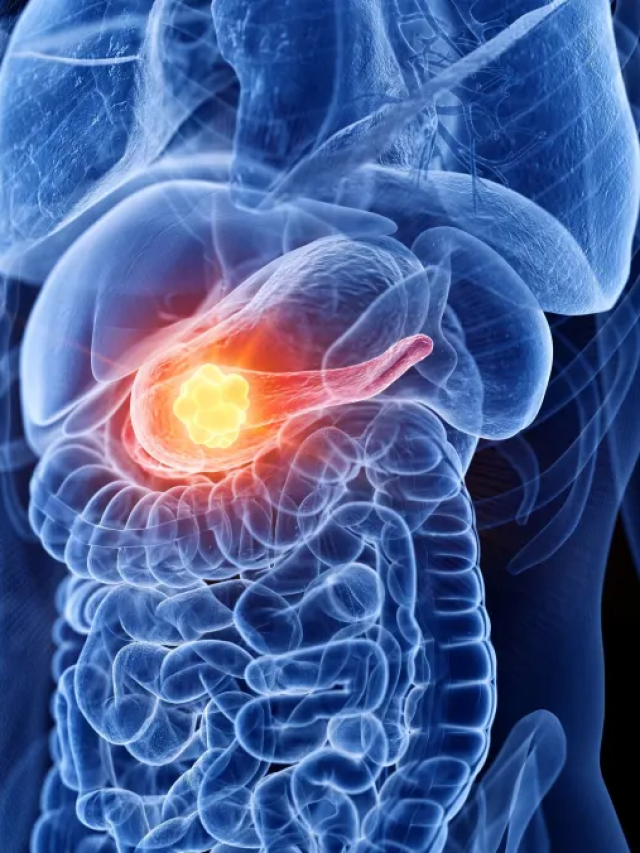 Estudo revela proteína ligada ao avanço do câncer de pâncreas