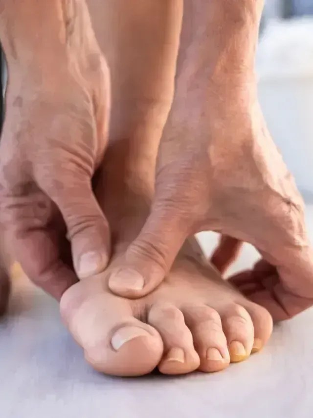 Joanete: por que surge, quando dói e como tratar para aliviar