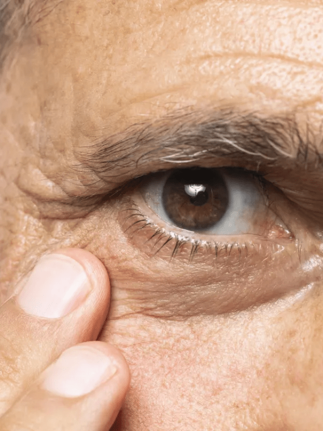 Glaucoma pode evoluir sem sintomas e comprometer visão permanentemente