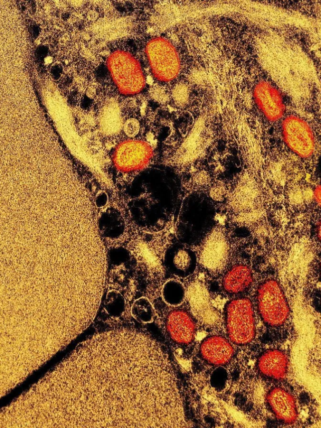 Estudo mostra que antiviral mais usado contra Mpox não é eficaz