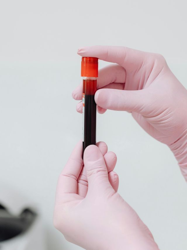 Mieloma múltiplo: entenda câncer da medula óssea e avanços na medicina