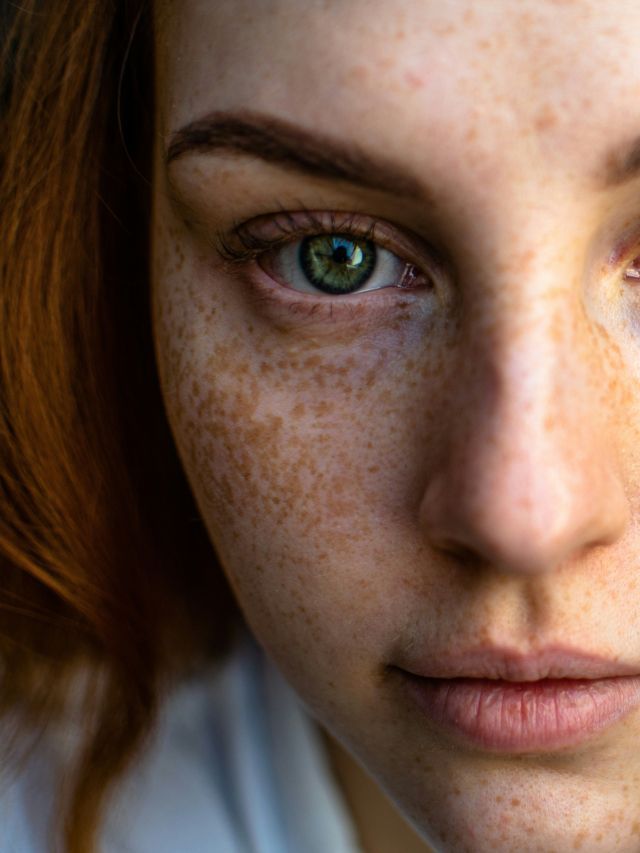 Como prevenir manchas e hiperpigmentação após o verão?