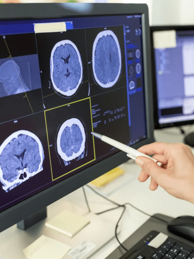 Tratamento de Alzheimer deve focar no sistema imune, sugere estudo