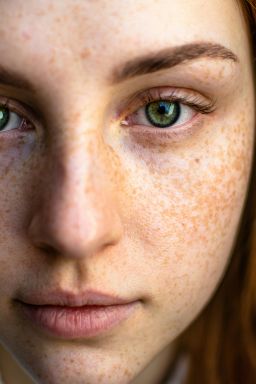 Como prevenir manchas e hiperpigmentação após o verão?