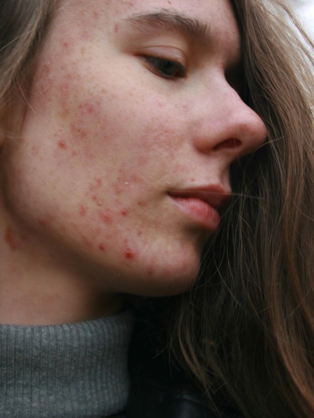 Acne: como acertar na rotina de cuidados e na escolha de produtos
