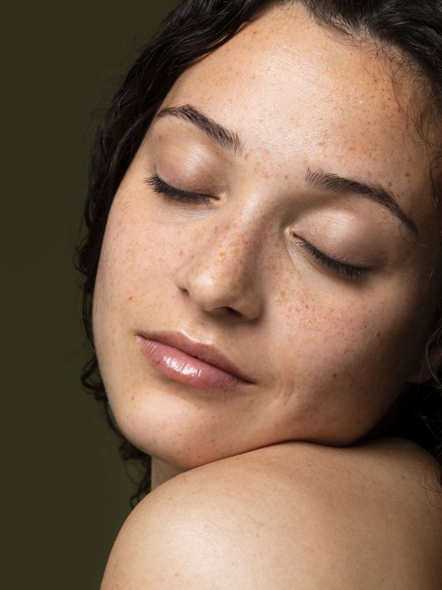 Melasma: quais produtos são indicados para o problema