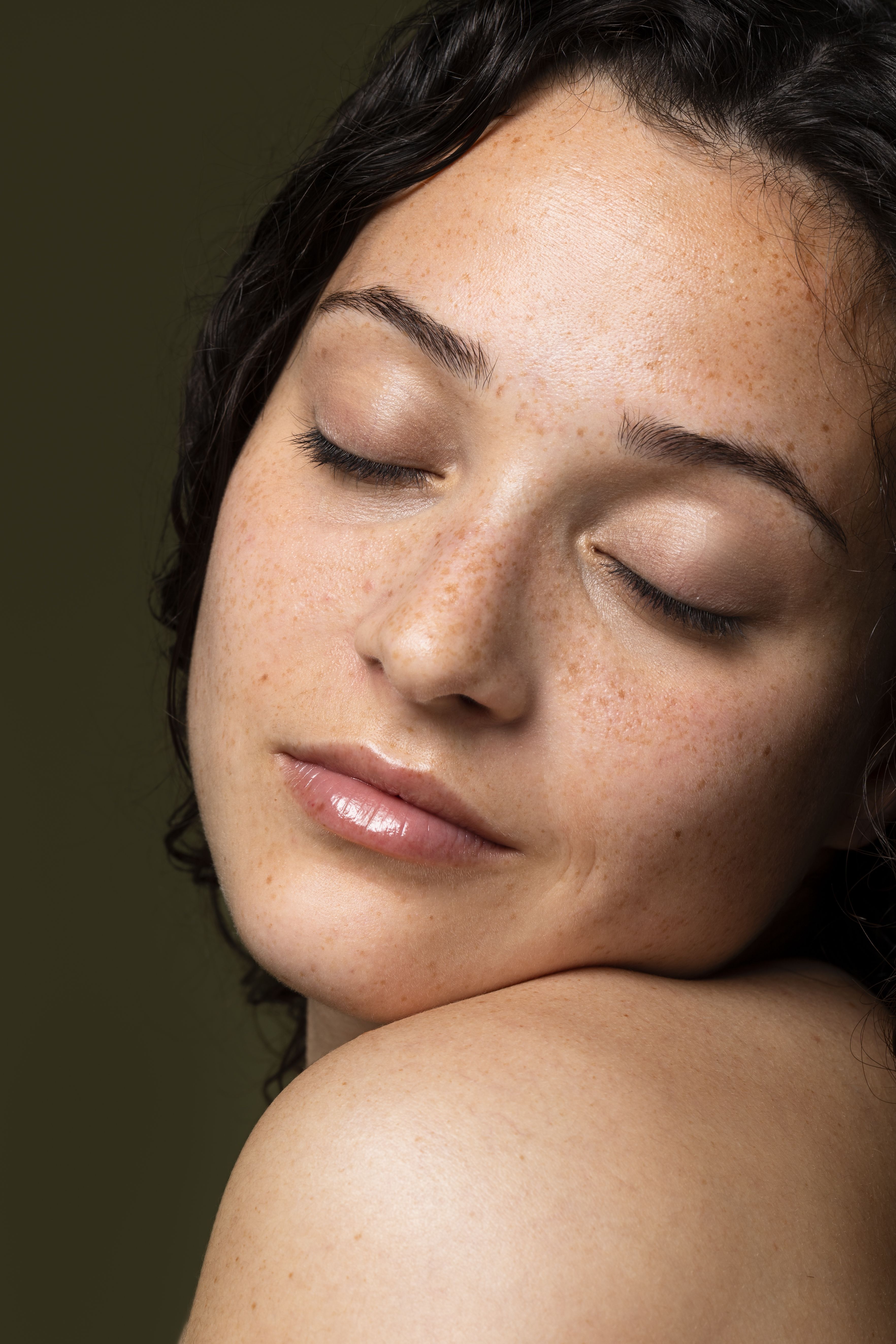 Melasma: quais produtos são indicados para o problema