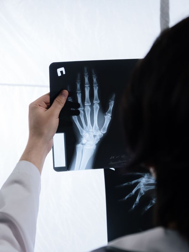 Osteoporose: a importância de cuidar do osso antes da próxima fratura