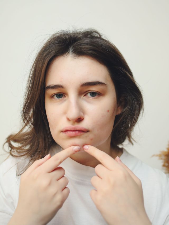 Dados mostram que 45% do jovens usam o Tiktok para tirar dúvida sobre acne
