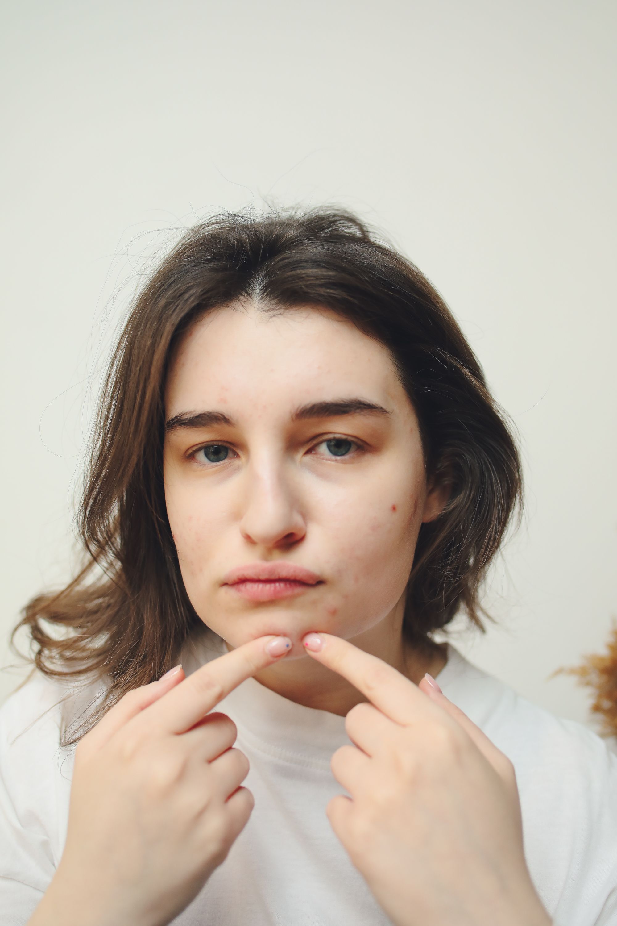 Dados mostram que 45% do jovens usam o Tiktok para tirar dúvida sobre acne